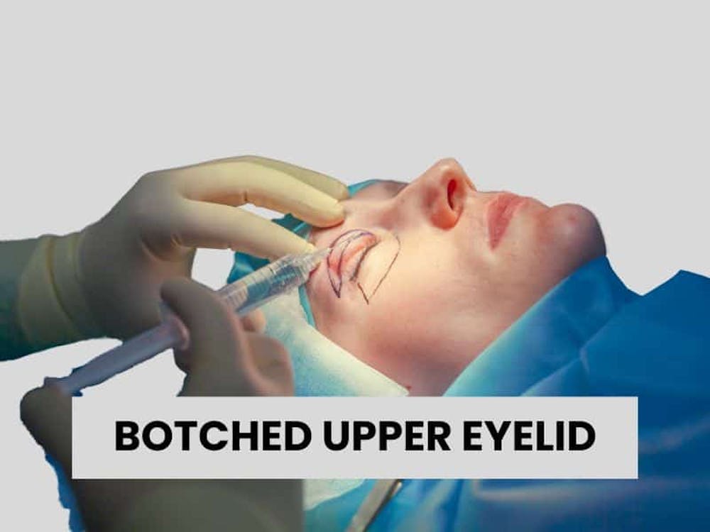 botched upper eyelid