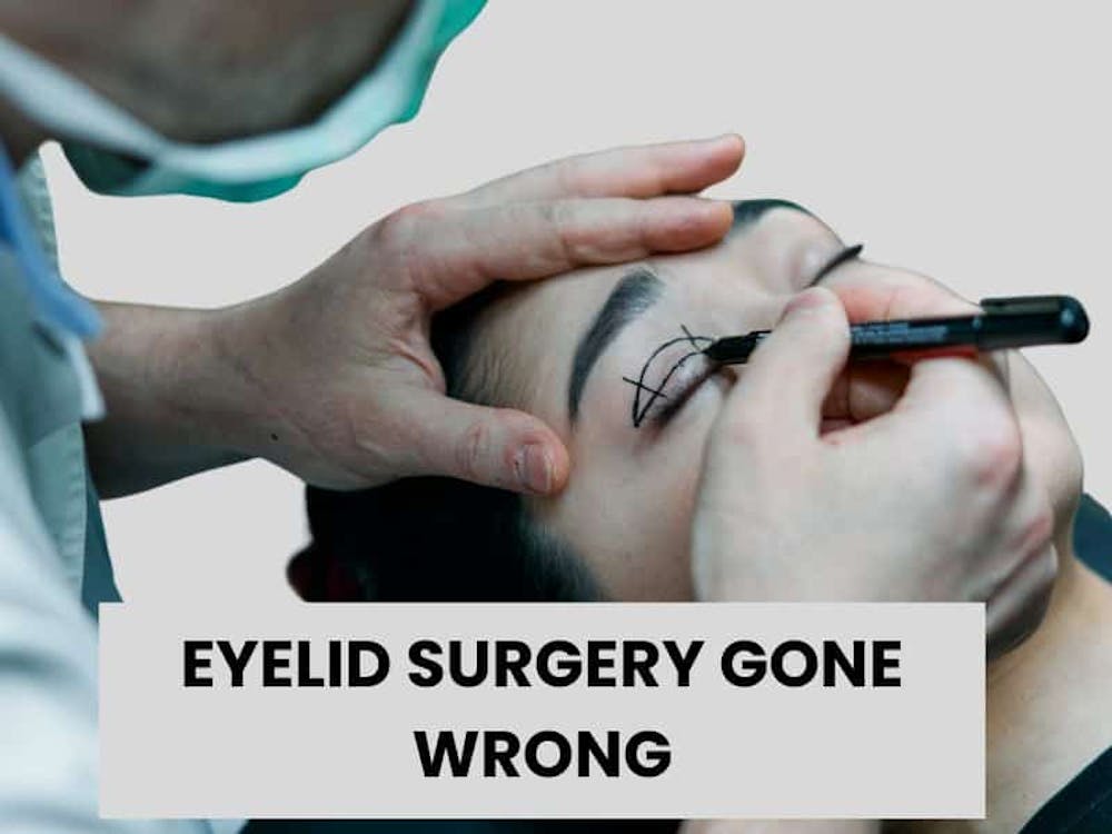 gone wrong botched upper eyelid surgery