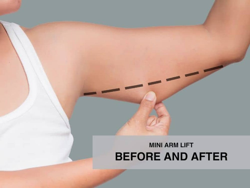 Mini Arm Lift before and after