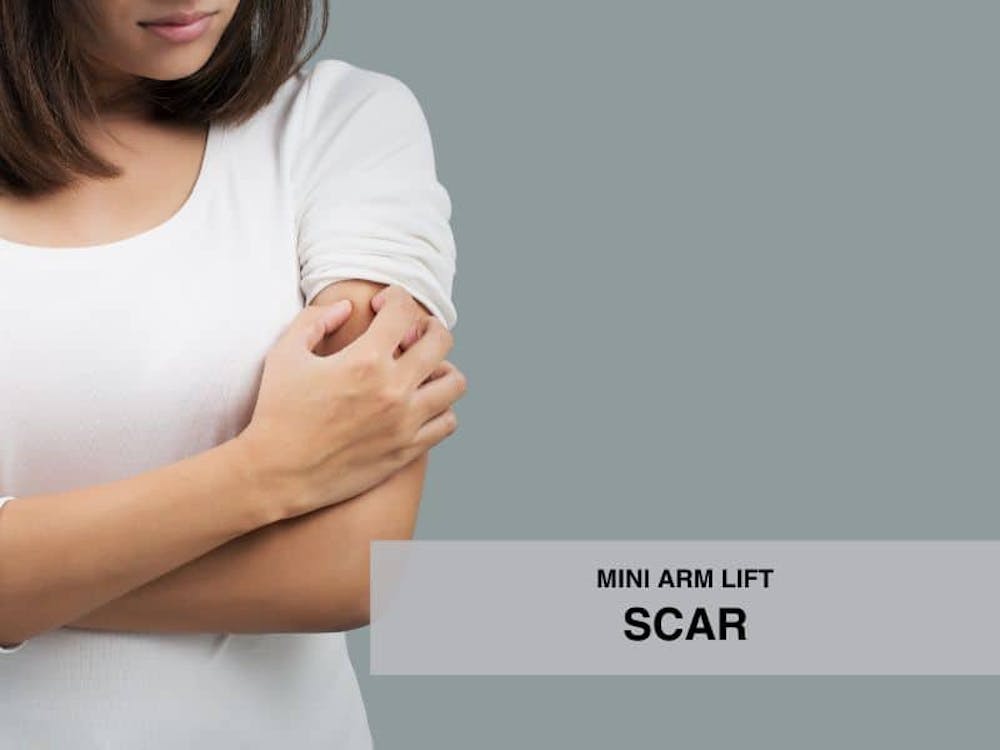 mini arm lift scar