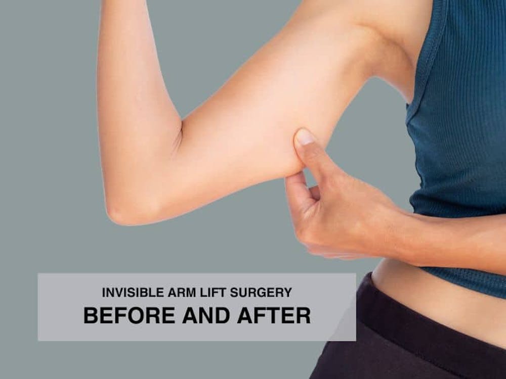 invisible arm lift surgery cost