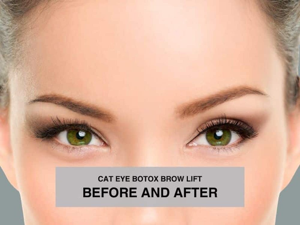 cat eye botox brow lift before and after cat eye botox brow lift before and after