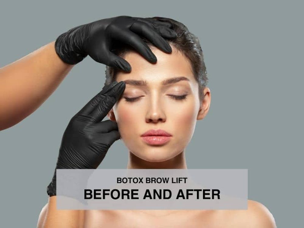 botox brow lift before and after botox brow lift before and after