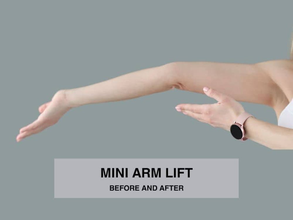 mini arm lift before and after mini arm lift before and after