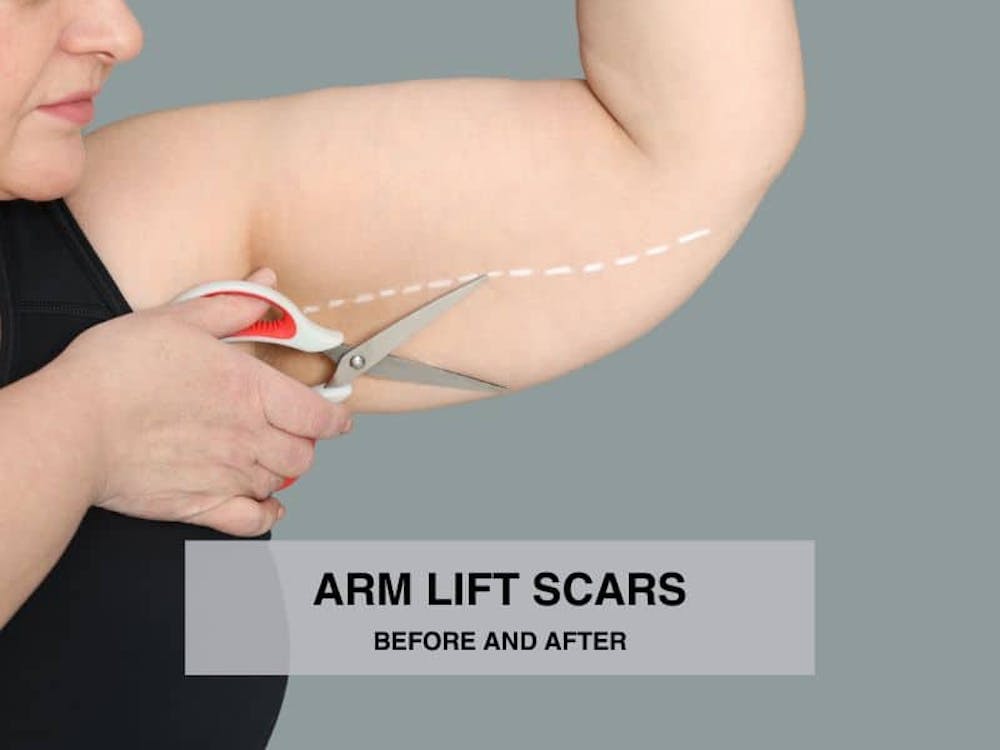 arm lift scars before and after arm lift scars before and after