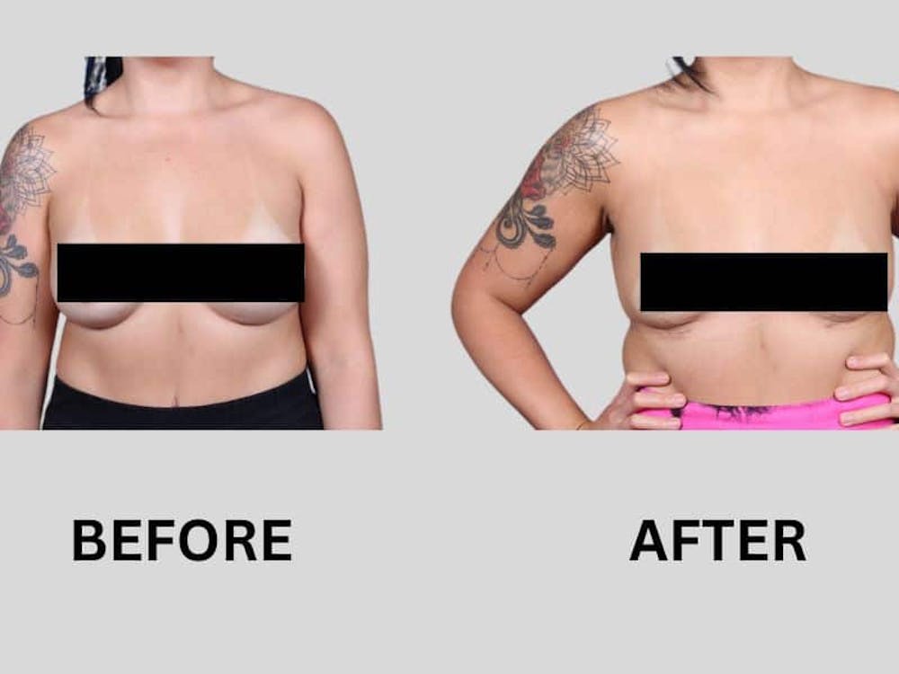 before and after breast implant removal before and after breast implant removal