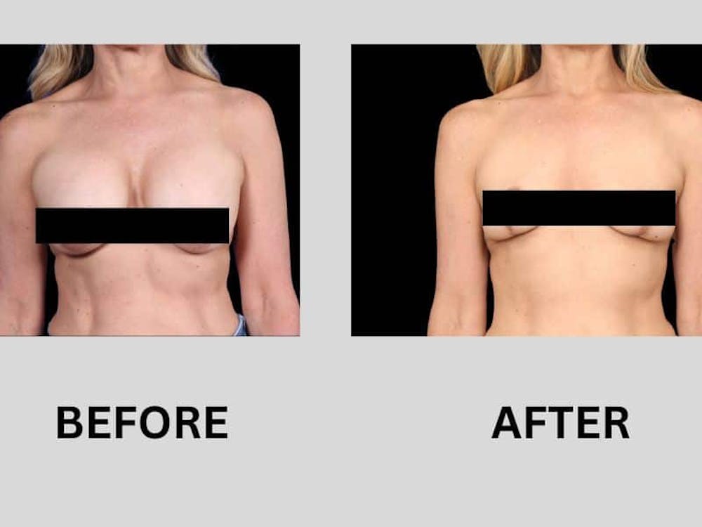 breast lift after implant removal before and after