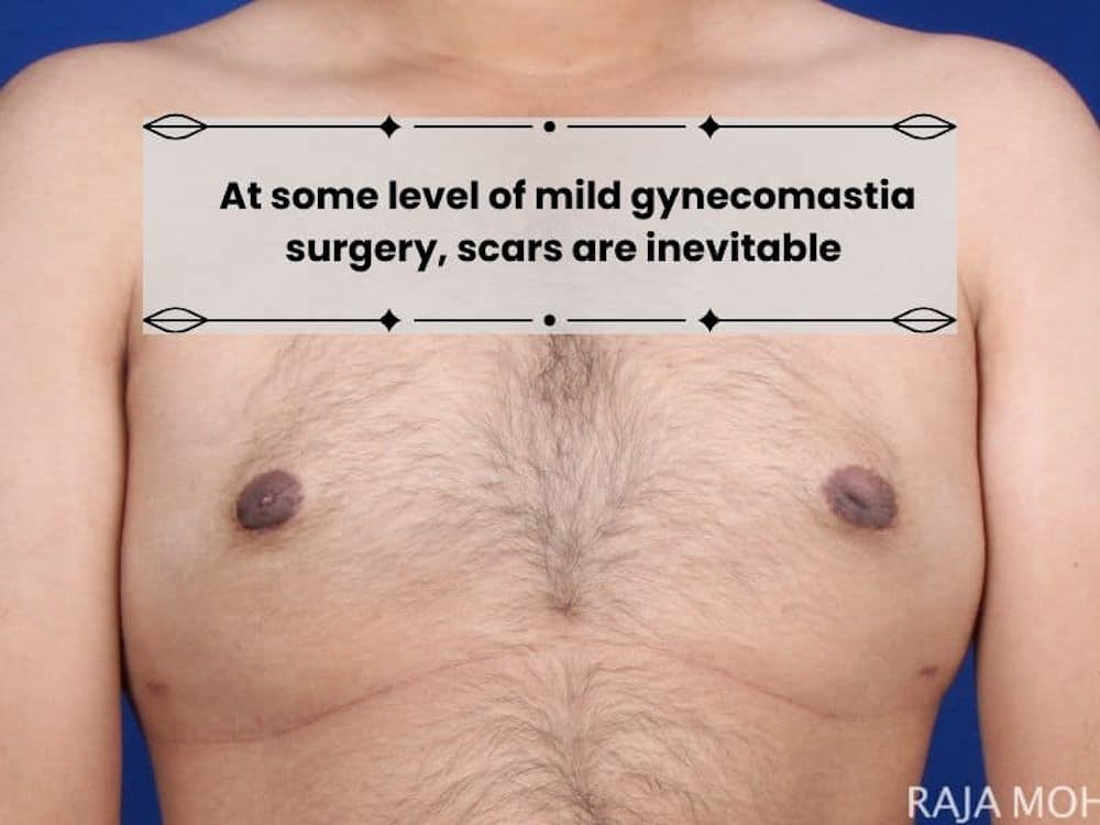 does gynecomastia surgery leave scars