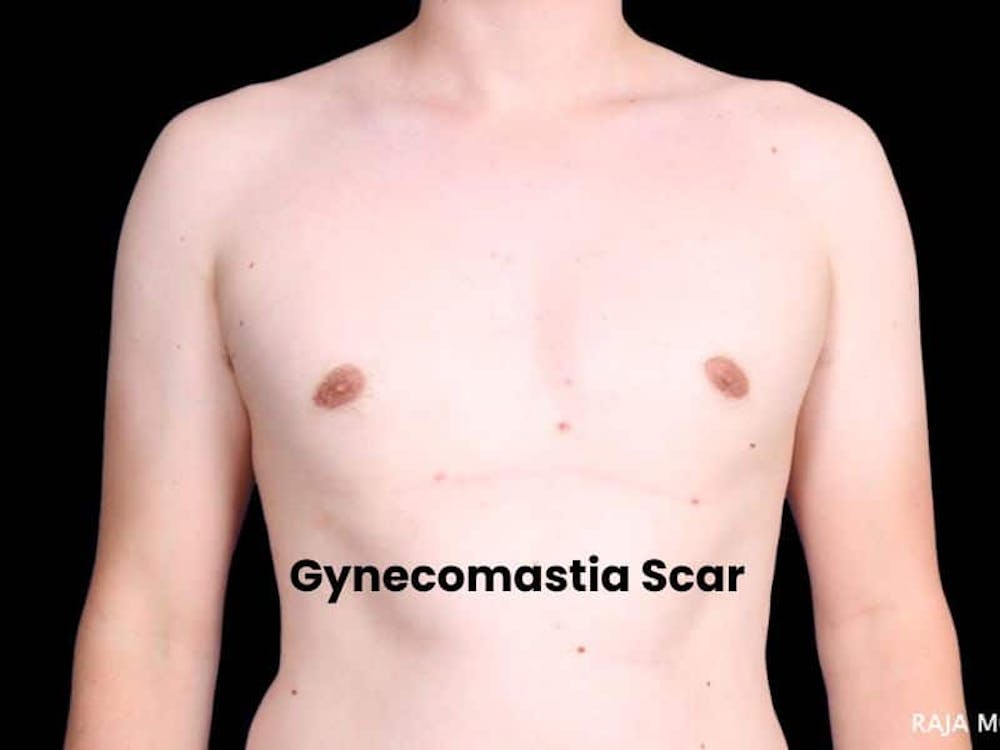 gynecomastia scars