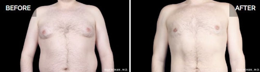 Gynecomastia vs chest fat pictures Gynecomastia vs chest fat pictures