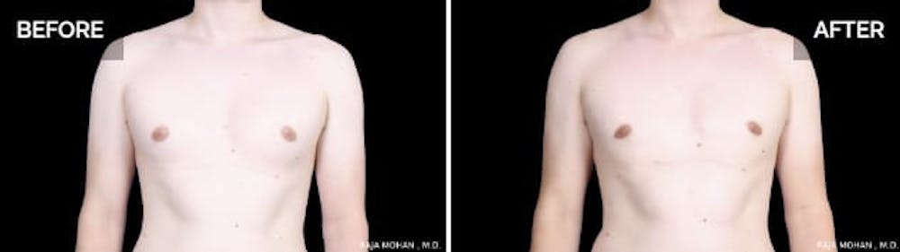 Gynecomastia vs fat pictures