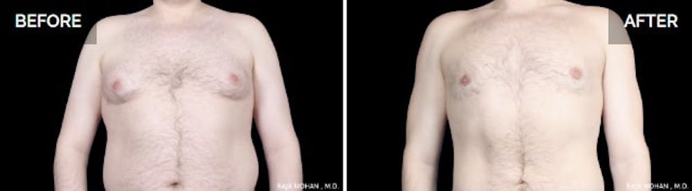 Chest fat vs Gyno
