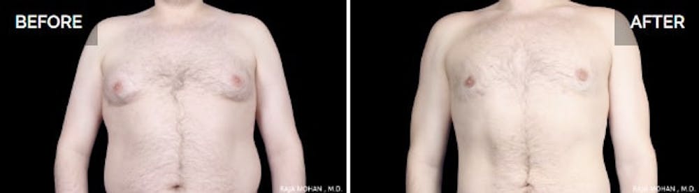 Chest fat vs Gyno