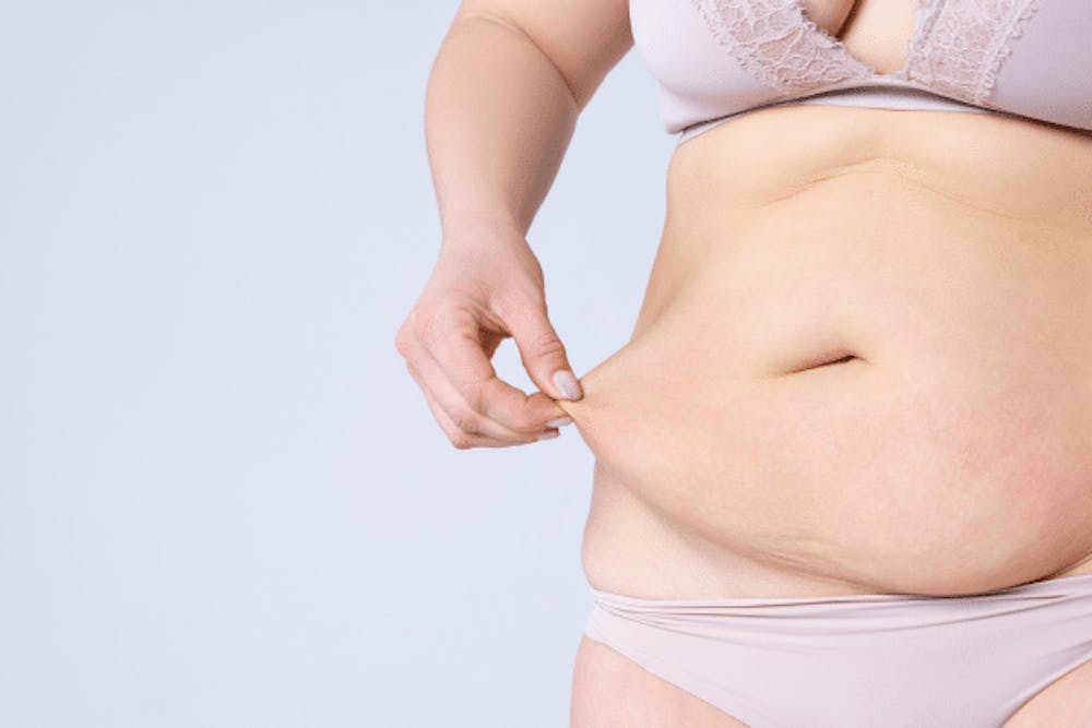 Tummy Tuck Results After 2 Months