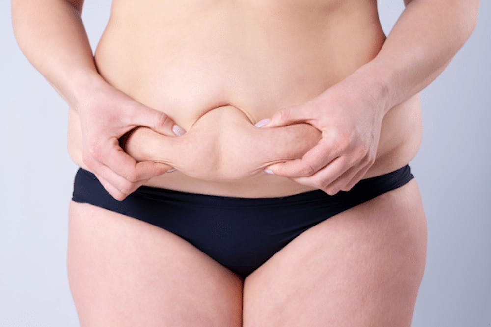 Questions To Ask Before Tummy Tuck Questions To Ask Before Tummy Tuck
