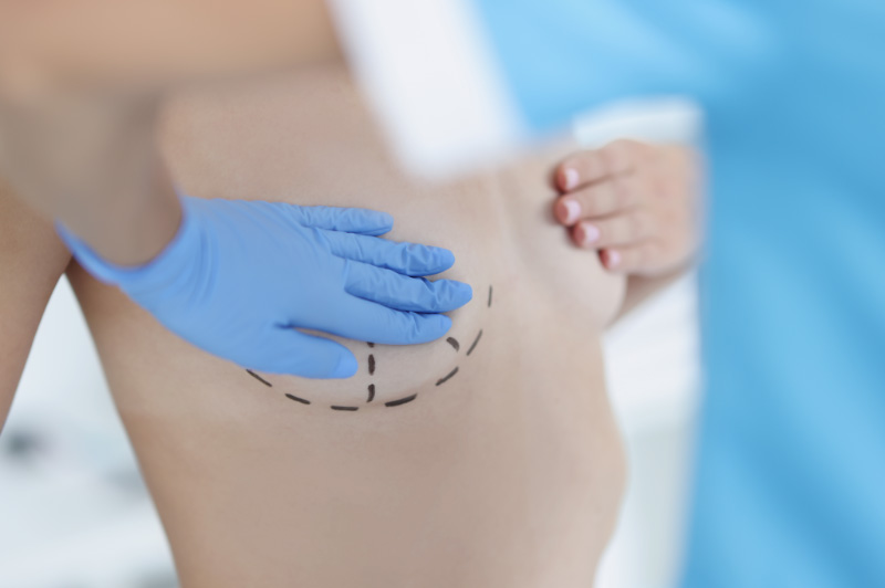 Understanding Types of Breast Augmentation Incisions | Plastic Surgery ...