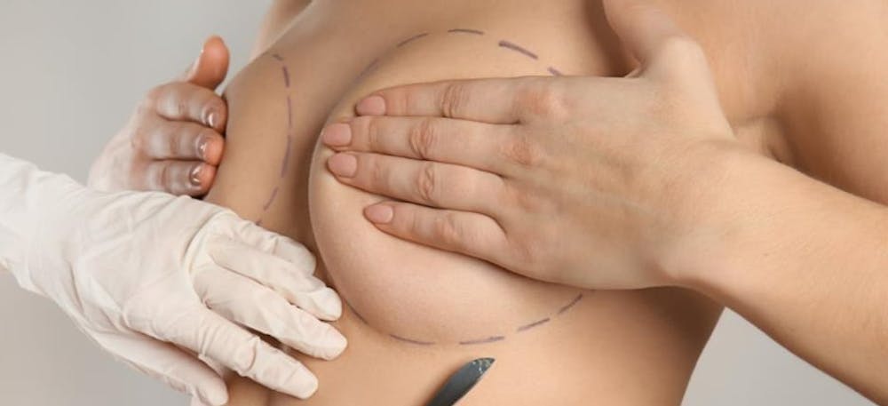 Breast Implant Incision Breast Implant Incision
