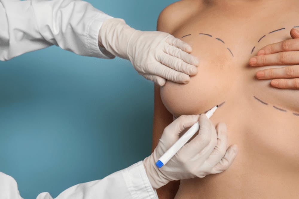Breast Implant Incision Healing Breast Implant Incision Healing