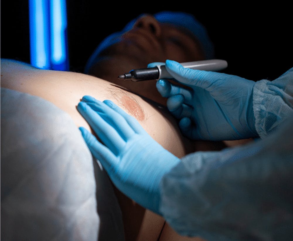 Cost Of Gynecomastia Surgery