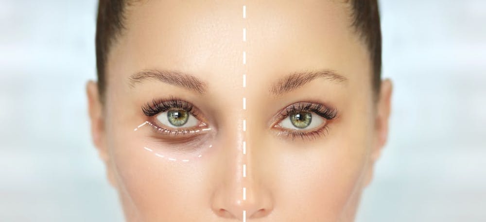 Eyelid Surgery Cost 2022 Eyelid Surgery Cost 2022