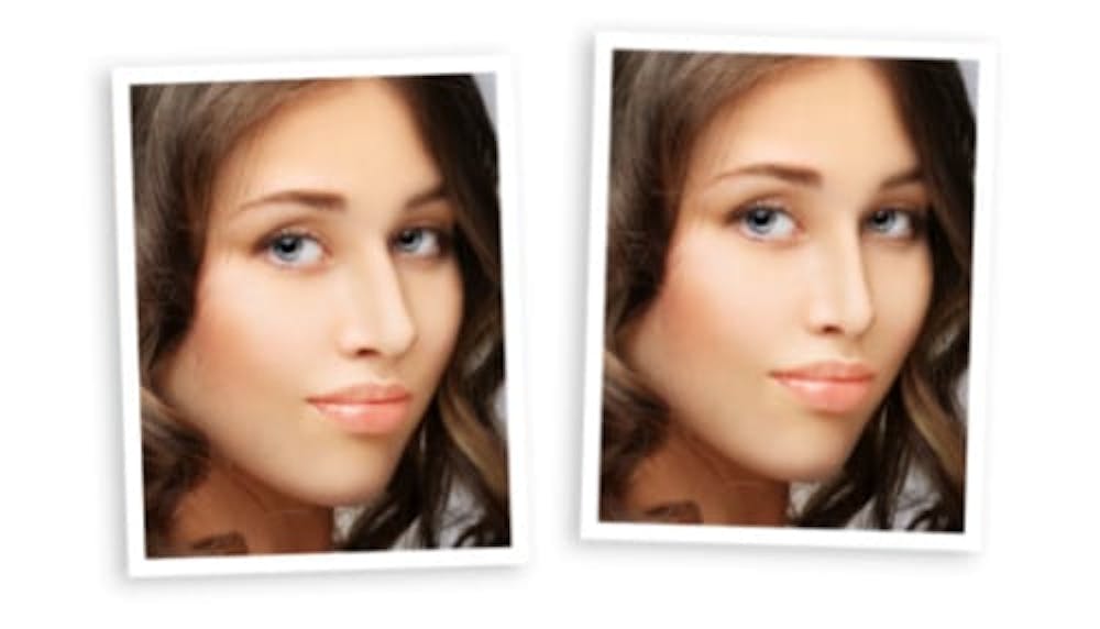 Nonsurgical rhinoplasty Nonsurgical rhinoplasty