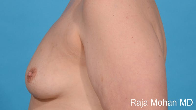 Breast Augmentation Before & After Gallery - Patient 412645 - Image 5