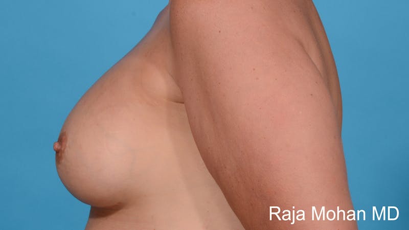 Breast Augmentation Before & After Gallery - Patient 412645 - Image 6