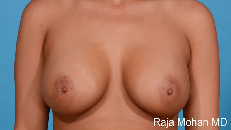 Breast Augmentation Before & After Gallery - Patient 663241 - Image 2
