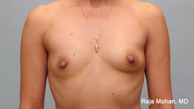 Breast Augmentation Before & After Gallery - Patient 297003 - Image 1