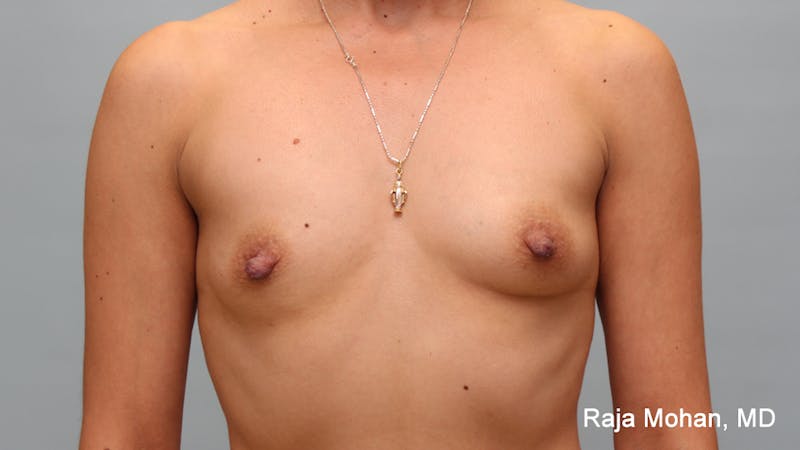 Breast Augmentation Before & After Gallery - Patient 297003 - Image 1
