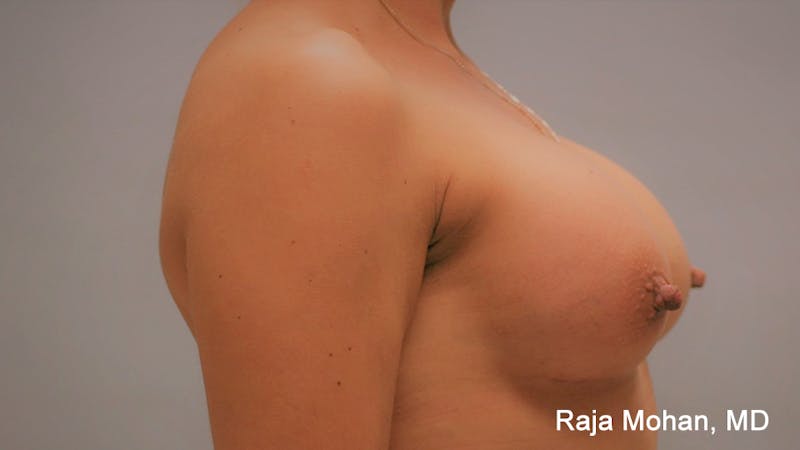 Breast Augmentation Before & After Gallery - Patient 297003 - Image 6