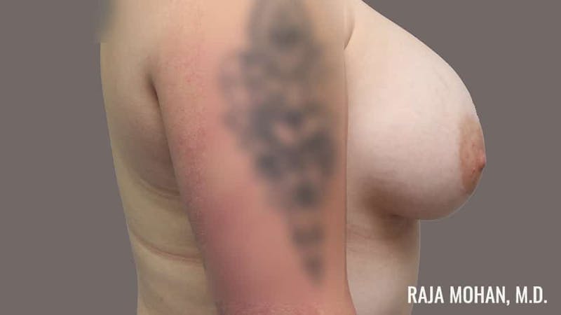 Breast Augmentation Before & After Gallery - Patient 324049 - Image 6