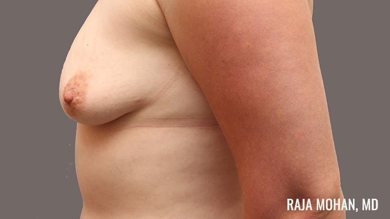 Breast Augmentation Before & After Gallery - Patient 324049 - Image 7