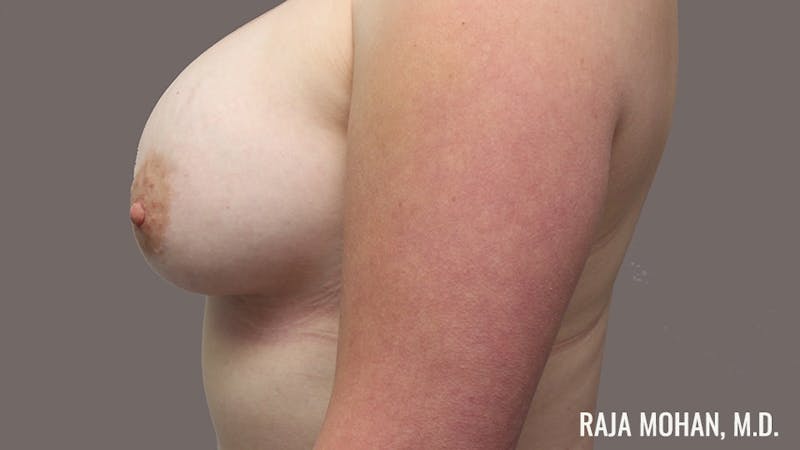 Breast Augmentation Before & After Gallery - Patient 324049 - Image 8