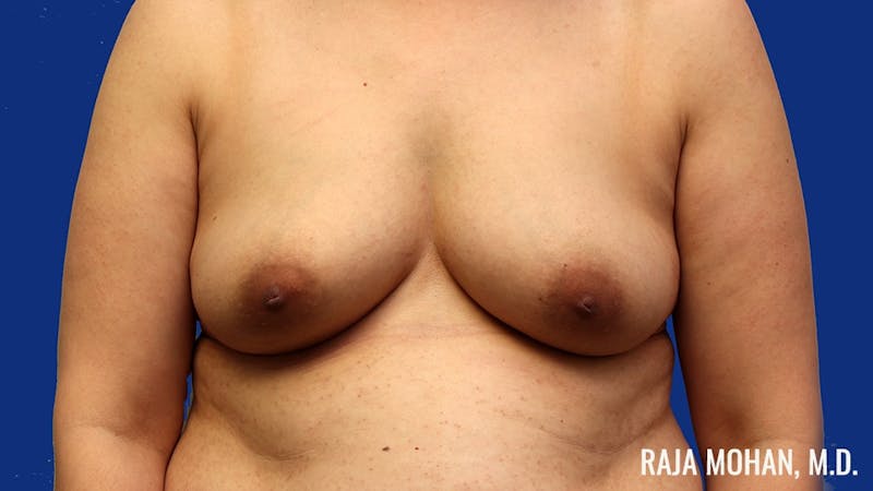 Breast Augmentation Before & After Gallery - Patient 224038 - Image 1