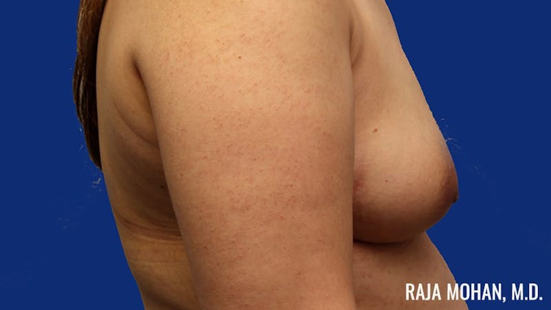 Breast Augmentation Before & After Gallery - Patient 224038 - Image 5