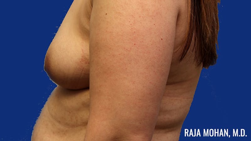 Breast Augmentation Before & After Gallery - Patient 224038 - Image 7