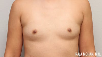 Breast Augmentation Before & After Gallery - Patient 941526 - Image 1