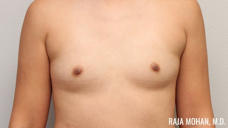 Breast Augmentation Before & After Gallery - Patient 941526 - Image 1
