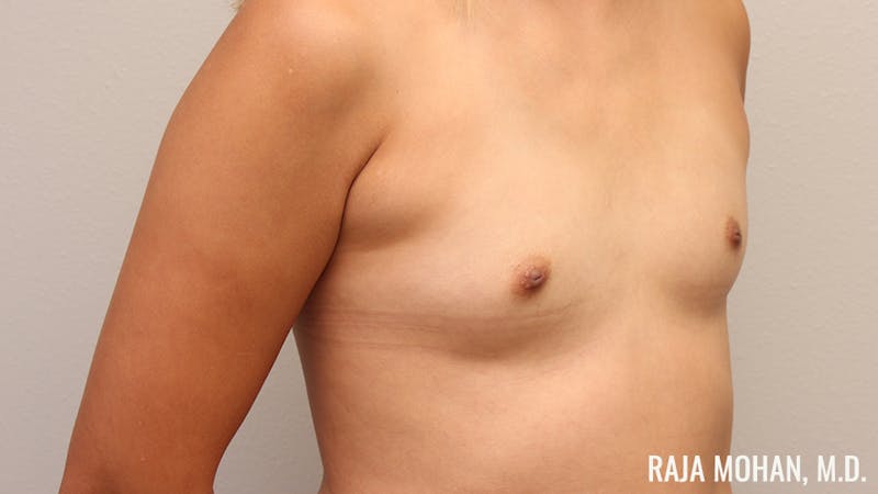 Breast Augmentation Before & After Gallery - Patient 941526 - Image 3