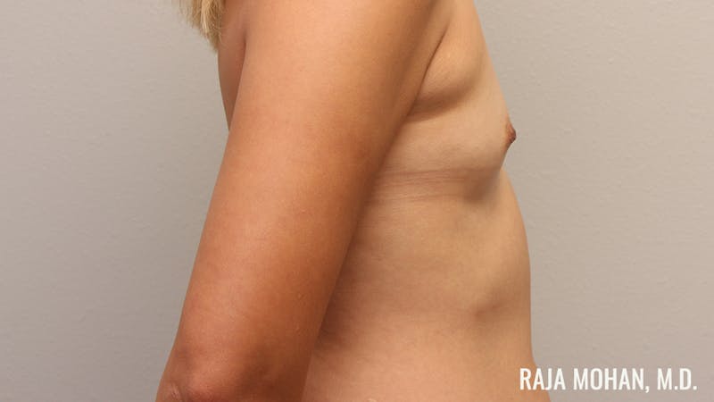 Breast Augmentation Before & After Gallery - Patient 941526 - Image 5