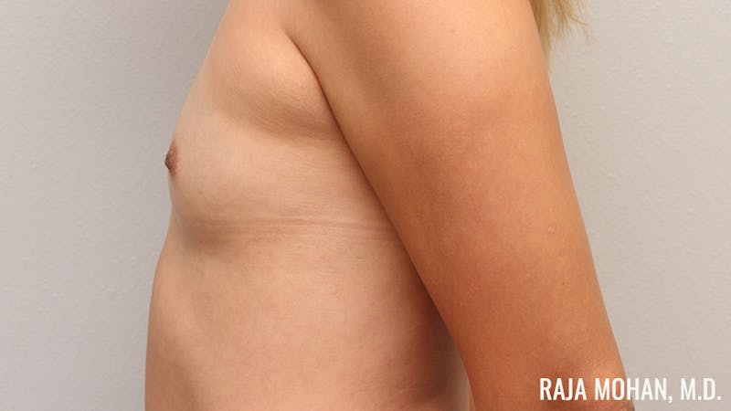 Breast Augmentation Before & After Gallery - Patient 941526 - Image 7