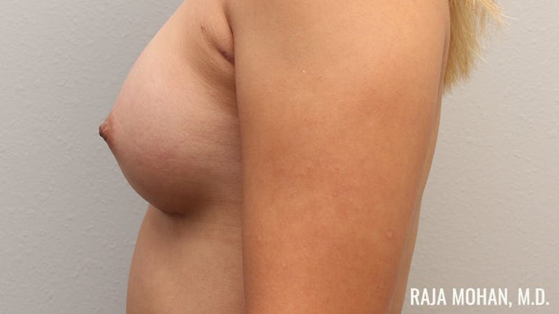 Breast Augmentation Before & After Gallery - Patient 941526 - Image 8