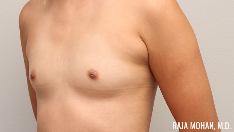 Breast Augmentation Before & After Gallery - Patient 941526 - Image 9