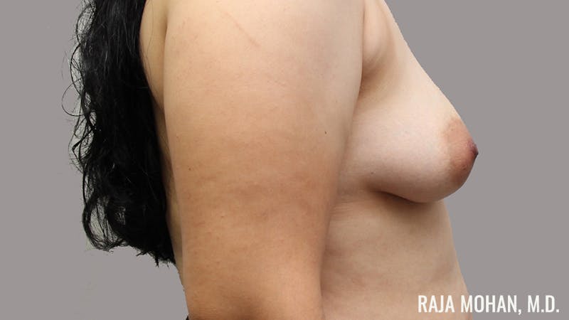 Breast Augmentation Before & After Gallery - Patient 390474 - Image 5