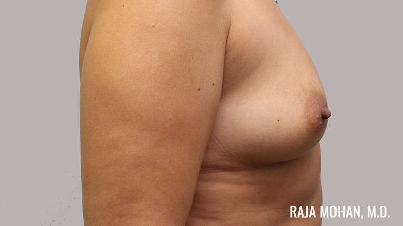 Breast Augmentation Before & After Gallery - Patient 171145 - Image 5