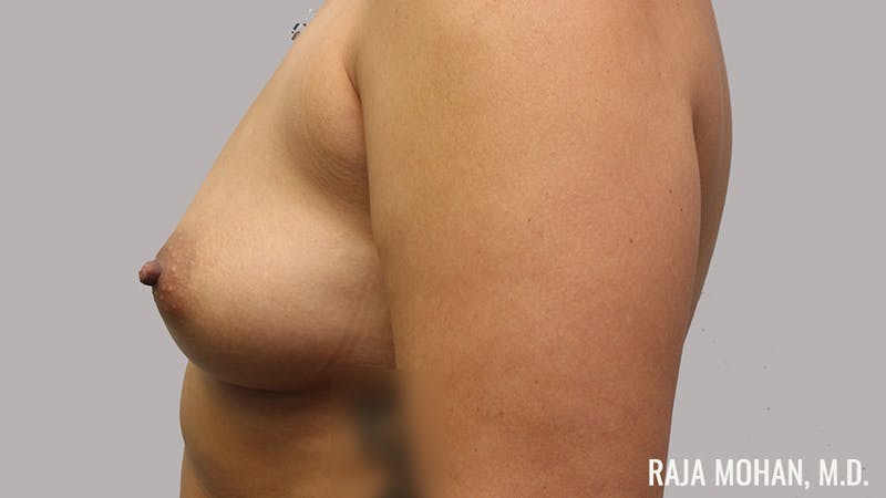 Breast Augmentation Before & After Gallery - Patient 171145 - Image 7