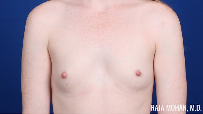 Breast Augmentation Before & After Gallery - Patient 217907 - Image 1