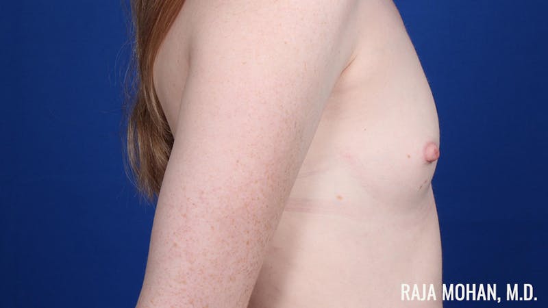 Breast Augmentation Before & After Gallery - Patient 217907 - Image 5