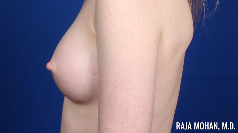 Breast Augmentation Before & After Gallery - Patient 217907 - Image 8